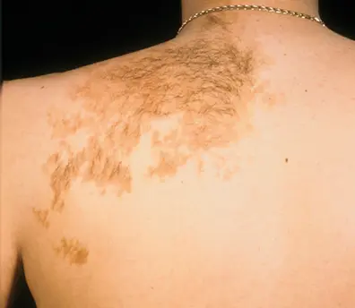 Becker-nevus