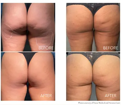 Cellulite-reduction