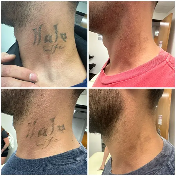 tattoo-removal-neck