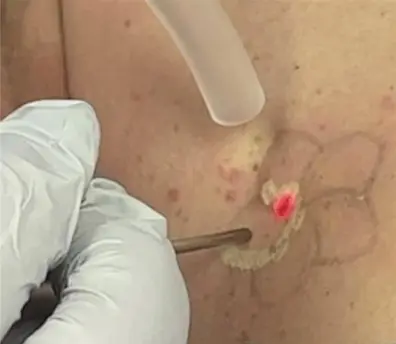 tattoo-removal